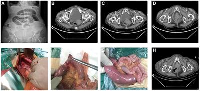 Case report: Obturator hernia: Diagnosis and surgical treatment